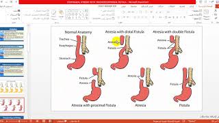 Tracheoesophageal Fistula TEF 2020 04 06 071811 [upl. by Ydoj]