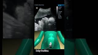 Baby Position Change Inside Womb Pregnancy Ultrasound baby babyboy babygirl girl boy shorts [upl. by Alissa]