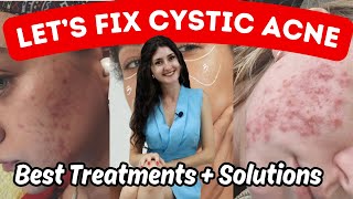 How To Get Rid Of Cystic Acne [upl. by Ettezzus]