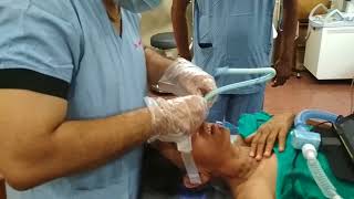 Video assisted Nasal Intubation [upl. by Norma440]