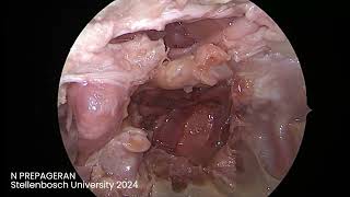 Module 10 Endoscopic Transclival approach and review of anatomy [upl. by Mairb]