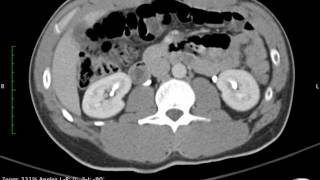 Ct Abdomen Testicular [upl. by Horowitz]