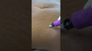 Stretch Marks Inkless Removal Boleyn Treatment Los Angeles 🌍 shorts [upl. by Nilam]