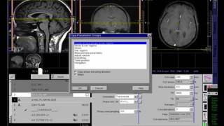 MRI BRAIN DEMO [upl. by Annaj]