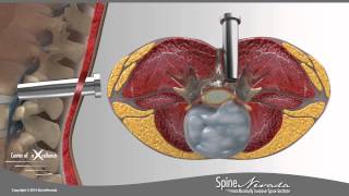 Lumbar Microdiscectomy  Spine Center Northern Nevada Northern California  Spine Surgery [upl. by Ressay]