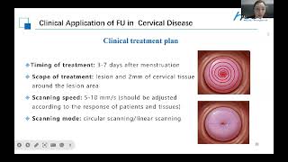 Focused Ultrasound for Cervical Intraepithelial NeoplasiaCIN [upl. by Ennagrom399]