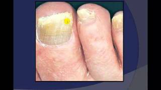 Toenail Debridement by a Podiatrist [upl. by Sheila320]