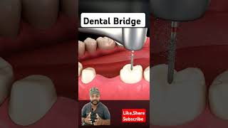 Amalgam removal and Dental Bridge Process 3D animationyt shorts 3d animation ytvideo asmr [upl. by Esylla410]