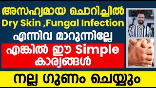 ചൊറിച്ചിൽDry skinFungal Infection എന്നിവ മാറുന്നില്ലെങ്കിൽ ഇങ്ങനെ ചെയ്ത് നോക്കുdry skinchorichil [upl. by Atinuj410]