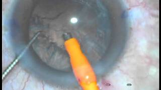 Cataract Surgery at JP Eye Hospital Mohali chandigarh By DrJatinder Singh [upl. by Prouty]