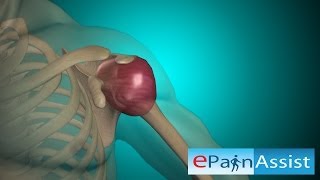 Frozen Shoulder or Adhesive Capsulitis Signs Causes Treatments [upl. by Iret]