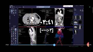 ct aortography ct siemens go now [upl. by Ahsieyt]