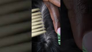 🥱🛌💤 Ultimate satisfying NITPICKING ampSCRATCHING whiteheads from his scalp asmr fyp viral [upl. by Elexa]