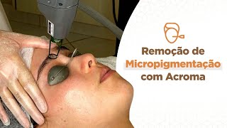 Remoção de Micropigmentação com Laser Acroma [upl. by Krantz538]