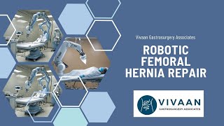 Robotic Femoral Hernia Repair  Minimally edited  Robotic Surgery  Dr Suril Vithalani [upl. by Edmanda]