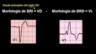 CURSO DE ELECTROCARDIOGRAFIA 48  EXTRASÍSTOLES VENTRICULARES [upl. by Strawn]