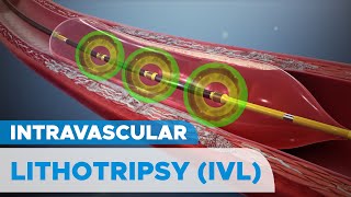 Shockwave Intravascular Lithotripsy IVL System for Severely Calcified Coronary Artery Plaques [upl. by Horan315]