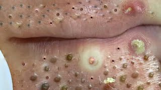 Big Cystic Acne Blackheads Extraction Blackheads amp Milia Whiteheads Removal Pimple Popping  703 [upl. by Kenta]