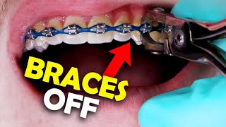 Braces Removal A StepbyStep Guide by an Orthodontist [upl. by Arne]