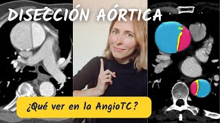 4 hallazgos clave en la DISECCIÓN AÓRTICA El que sabe lo que busca lo encuentra [upl. by Medorra]