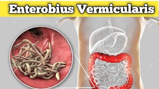 Enterobius vermicularis Habitat life cycle and pathogenicity etc [upl. by Hoffert747]