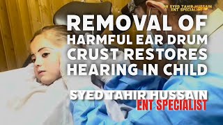 Removal of Harmful Ear Drum Crust Restores Hearing in Child  Effective Ear Treatment [upl. by Eenel]