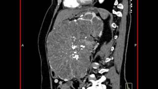 Abdomen Pancreas Pancreatic Mass 3D images demonstrate a large cystic pancreatic mass8 of 10 [upl. by Alur553]