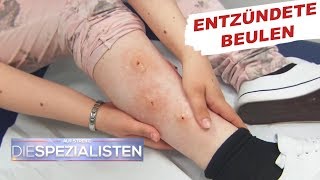 Beulen an den Beinen Parasitenbefall  Auf Streife  Die Spezialisten  SAT1 TV [upl. by Thanasi133]