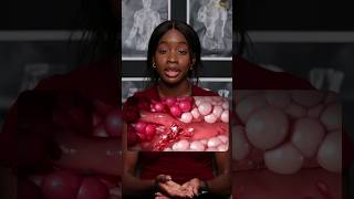 Sickle Cell Anaemia Explained and Simplified [upl. by Ivo]