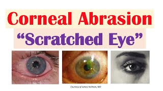 Corneal Abrasion “Scratched Eye”  Causes Signs amp Symptoms Diagnosis Treatment [upl. by Kaspar]