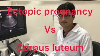 Sonography ectopic pregnancy vs corpus luteum [upl. by Idac691]