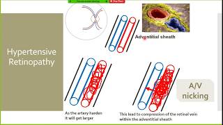 Hypertensive Retinopathy PathophysiologyPart 1 [upl. by Barcus]