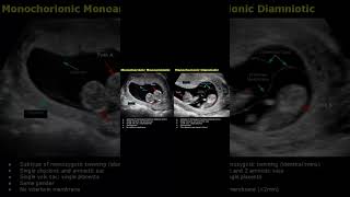 Monochorionic Monoamniotic amp Monochorionic Diamniotic Twins Ultrasound Scan  Pregnancy USG shorts [upl. by Ettennad]