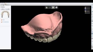 2013 3Shape Digital Denture from Kastle Mills Lee Cain Designs [upl. by Assennej]