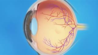 Torn Retina Photocoagulation [upl. by Nuahsel451]