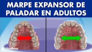 MARPE EXPANSOR de PALADAR  Así funciona el disyuntor de ortodoncia en adultos © [upl. by Eninnaej]