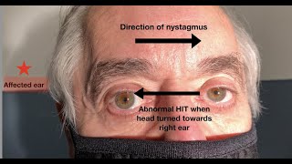 What ear does the nystagmus in vestibular neuritis beat towards [upl. by Nyrb]