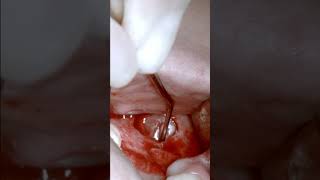 Maxillary Sinus Lift with Lateral Window Technique and Simultaneous GBR [upl. by Nalani]