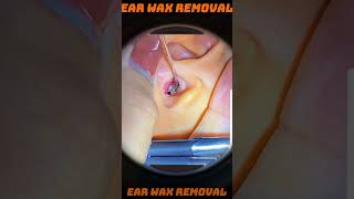 Ear Wax Removal 27 ears earwaxremoval asmr satisfying [upl. by Azil]