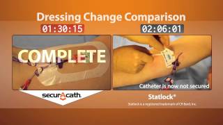 SecurAcath vs Statlock dressing change [upl. by Adah]