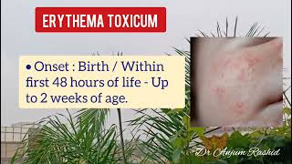 Newborn Baby Rash Erythema Toxicum Neonatorum Causes Symptoms Diagnosis amp Treatment [upl. by Normak]