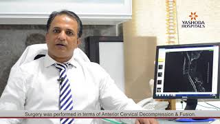 Anterior Cervical Decompression with Fusion treated by Dr Kiran Kumar Lingutla  Yashoda Hospitals [upl. by Sima615]