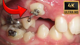 🔥Unexpected orthodontic impaction🔥Timelapse of BRACES in 4K [upl. by Rosabel]