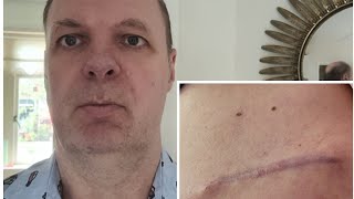 I was Diagnosed with Skin Cancer Melanoma Gevonden op moedervlek huidkankerMelanoom [upl. by Tav110]