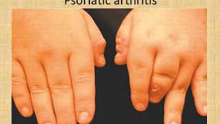 Approach to Polyarthritis Patient By Dr Haidy Ali [upl. by Greg632]