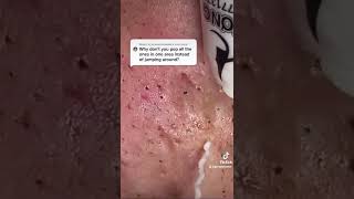 Cystic Acne Removal amp Inflammatory Acne [upl. by Asiilanna336]