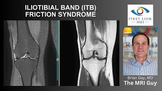 ILIOTIBIAL BAND ITB FRICTION SYNDROME [upl. by Enelrahc]