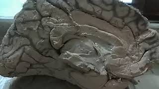 Medial surface of cerebrum real viscera [upl. by Eal]