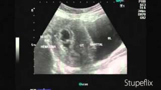 Ultrasound video of subchorionic hematoma early pregnancy [upl. by Azaleah]