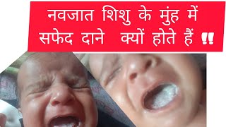 Oral thrush in newbornनवजात शिशु के मुंह में सफेद दाने क्यूं होते है awareness education doctor [upl. by Edith340]